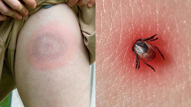 lyme disease