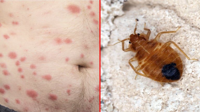 bed bugs