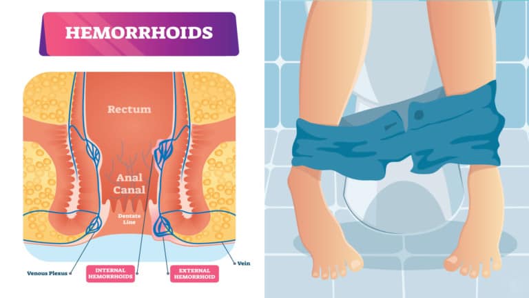 hemorrhoids