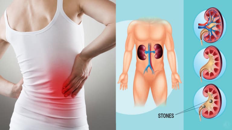 kidney stones