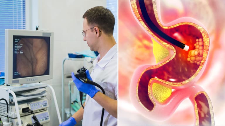colonoscopy