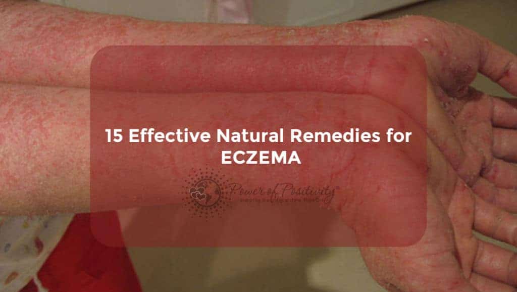 15 Effective Natural Remedies for Eczema