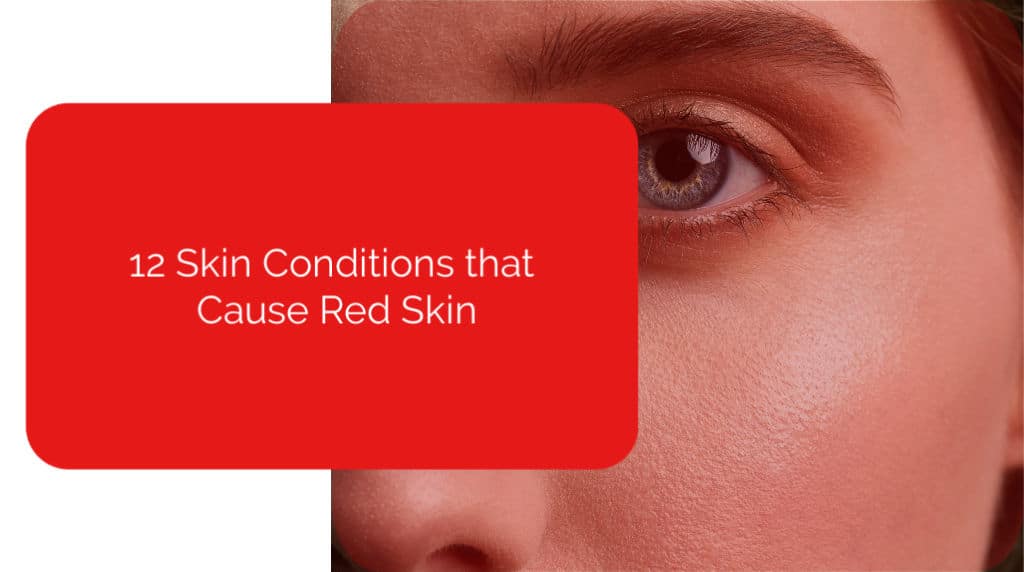 12 Skin Conditions that Cause Red Skin