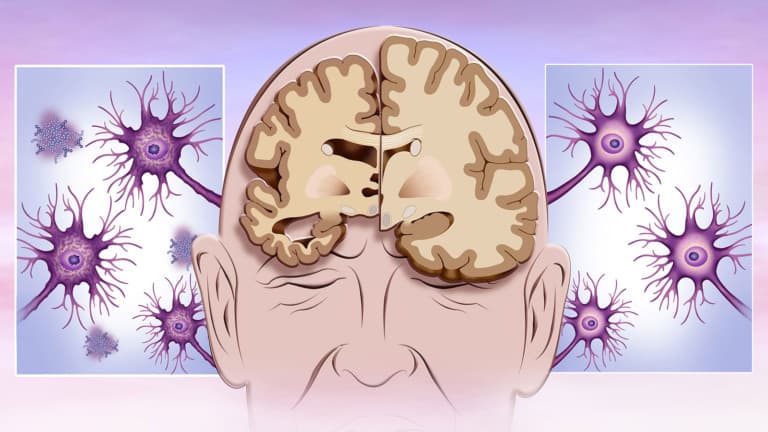 Alzheimers