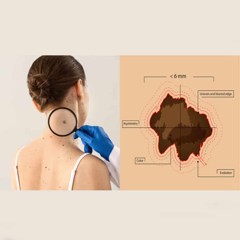 skin cancer prevention tips