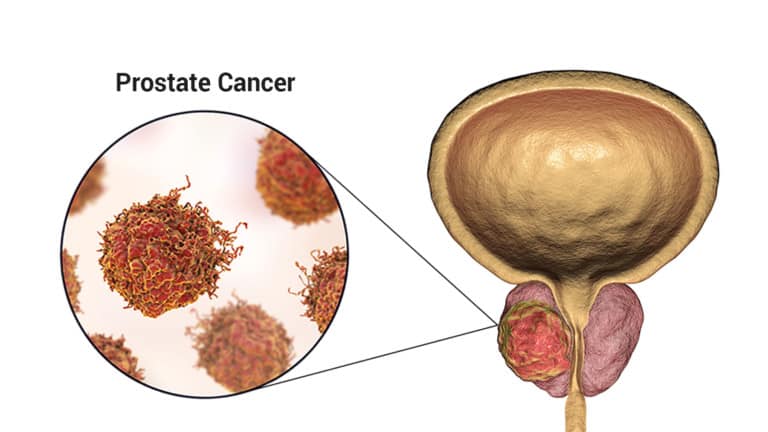 prostate cancer