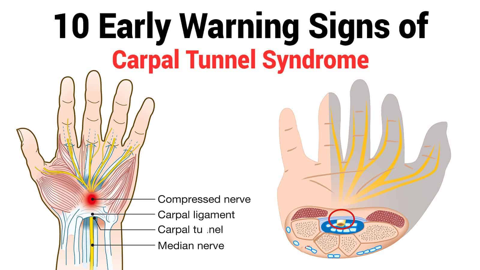 10 Early Warning Signs of Carpal Tunnel Syndrome