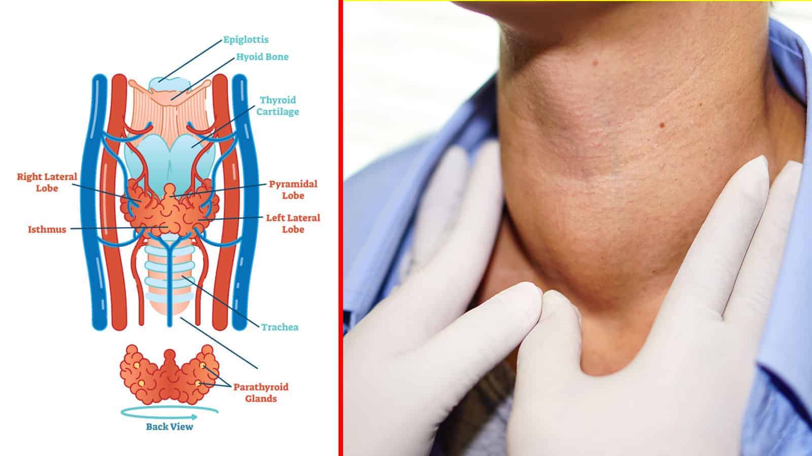 10 Signs of Thyroid Cancer That Most People Miss