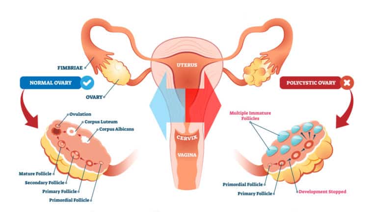 PCOS