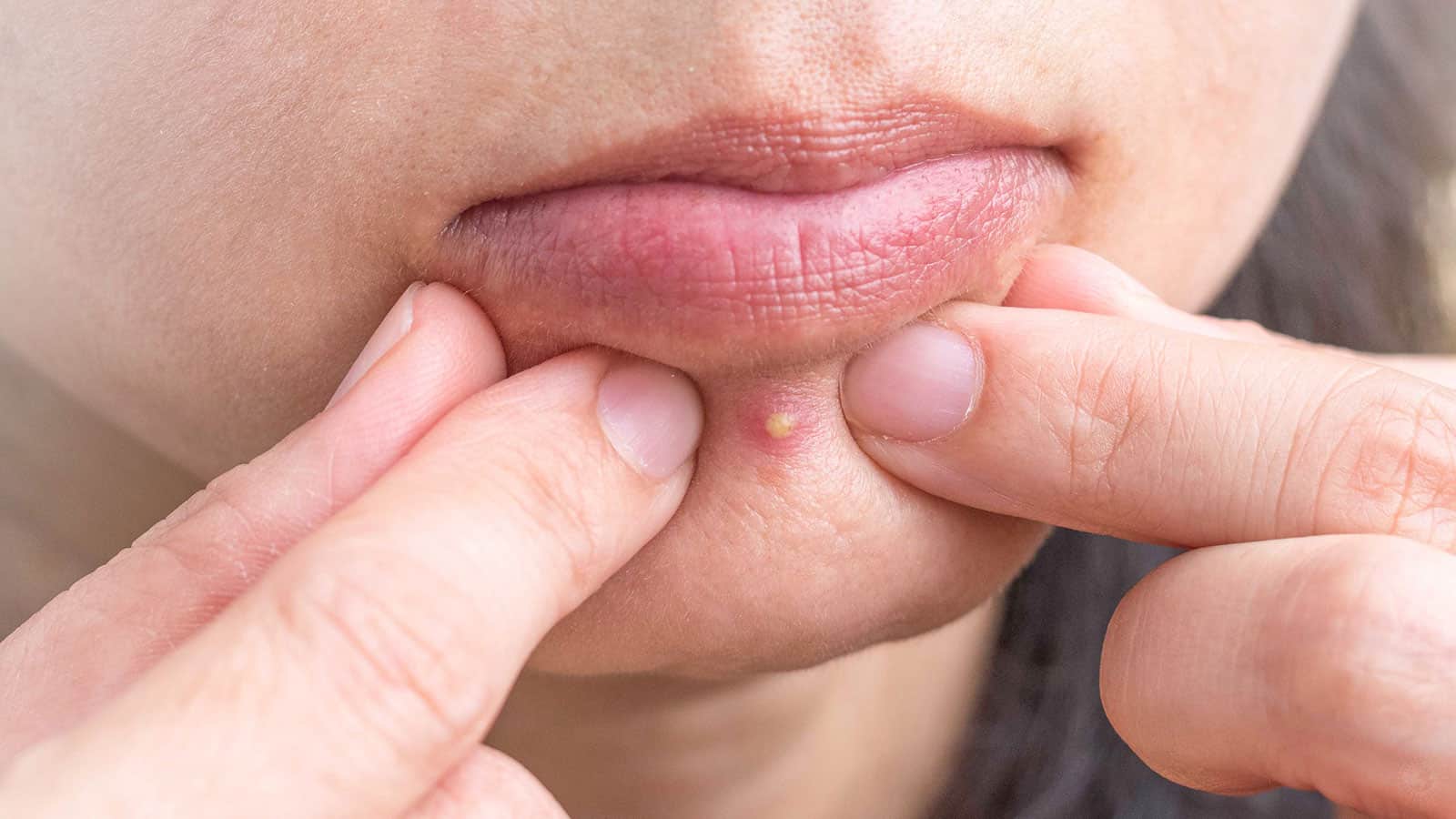 Dermatologists Explain Why You Should Never Pop Pimples