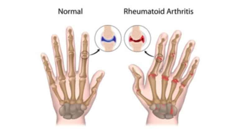 rheumatoid arthritis