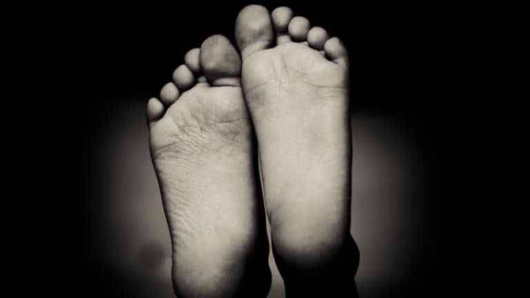 plantar fasciitis
