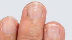 fingernail health