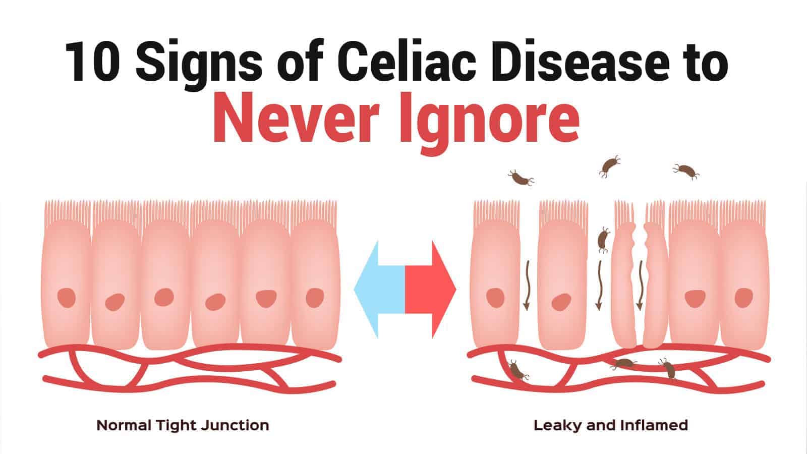 10 Signs of Celiac Disease to Never Ignore