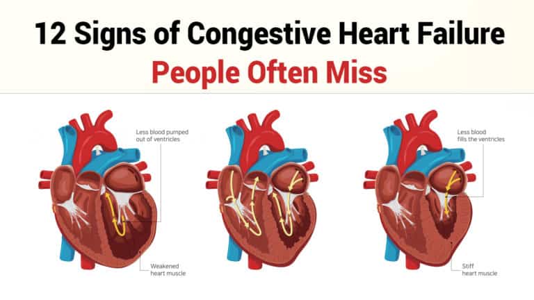 congestive heart failure