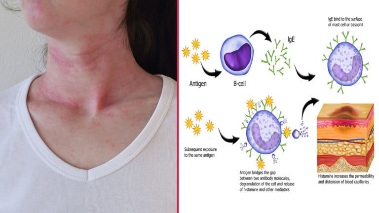food allergy