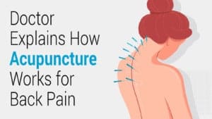 acupuncture for back pain