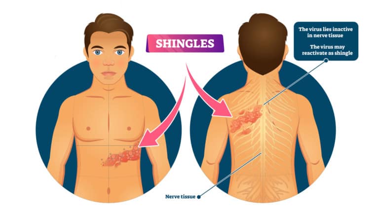 shingles