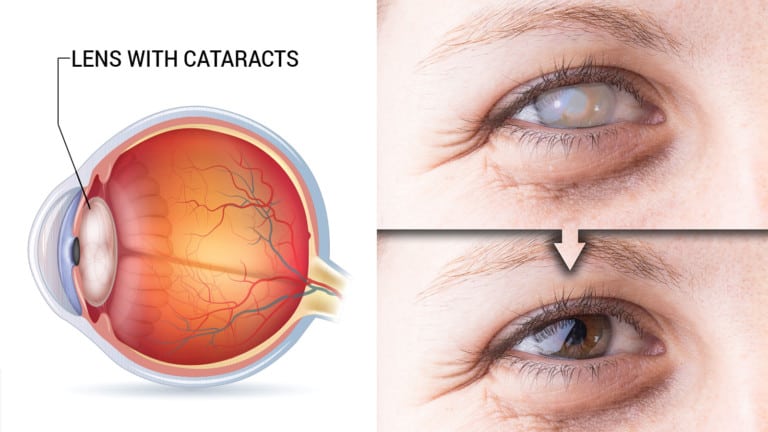 cataracts