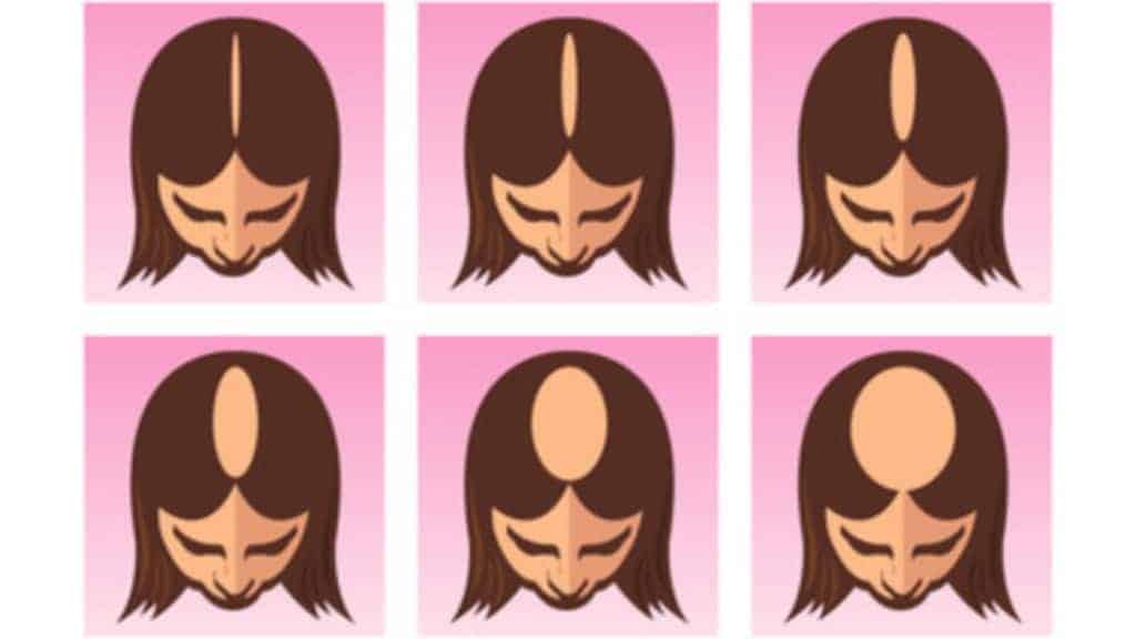 12 Natural Beauty Hacks No Woman with Alopecia Should Ignore