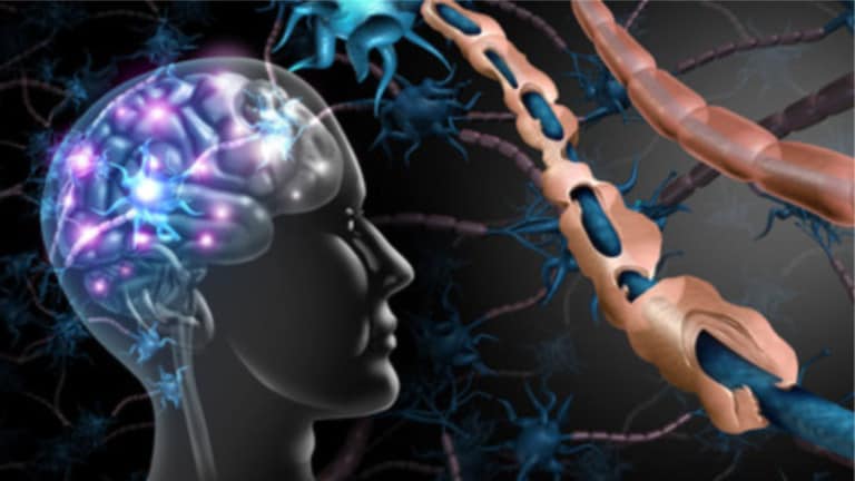 multiple sclerosis