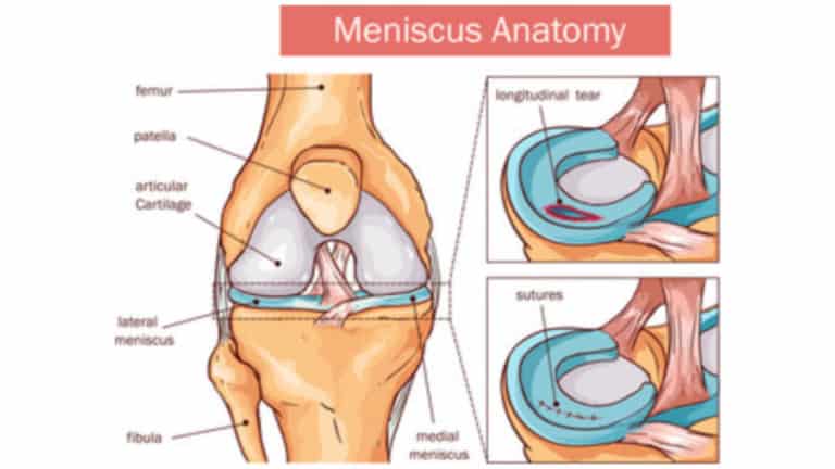 torn meniscus