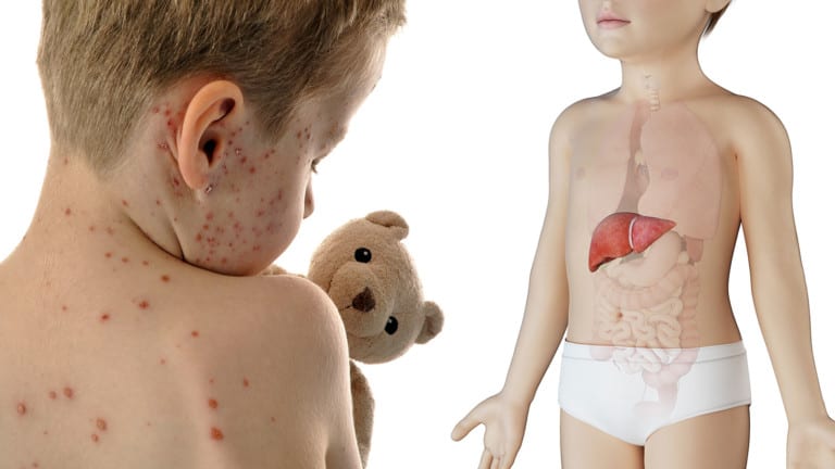 reye's syndrome