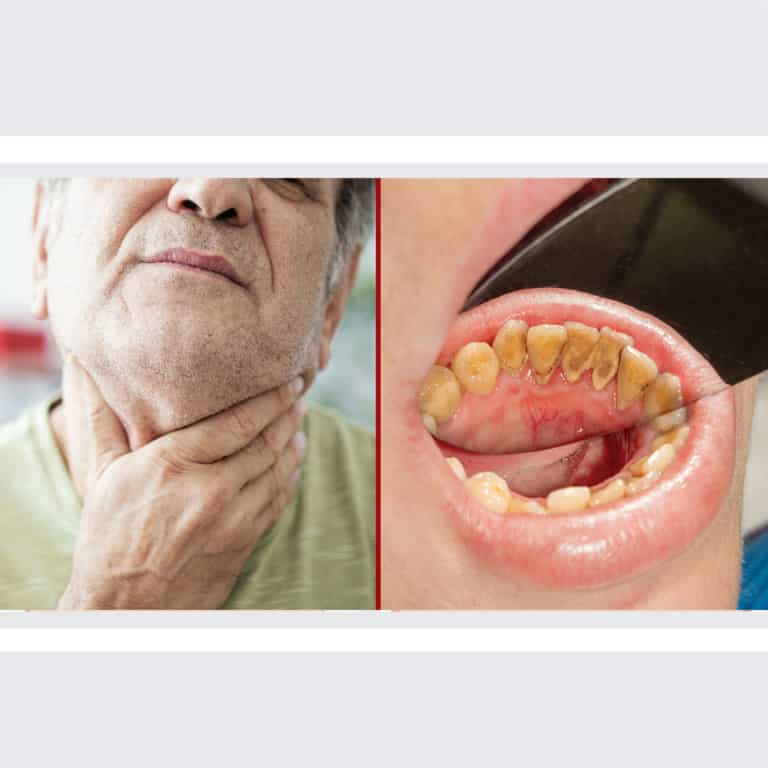 oral cancer