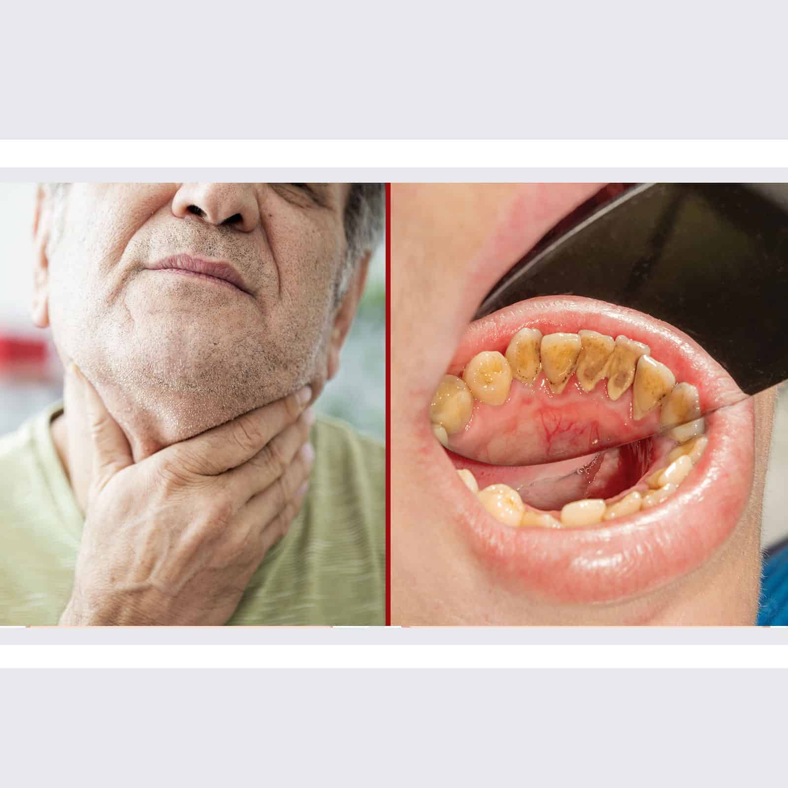 Oncologist Reveals the Causes and Early Signs of Oral Cancer
