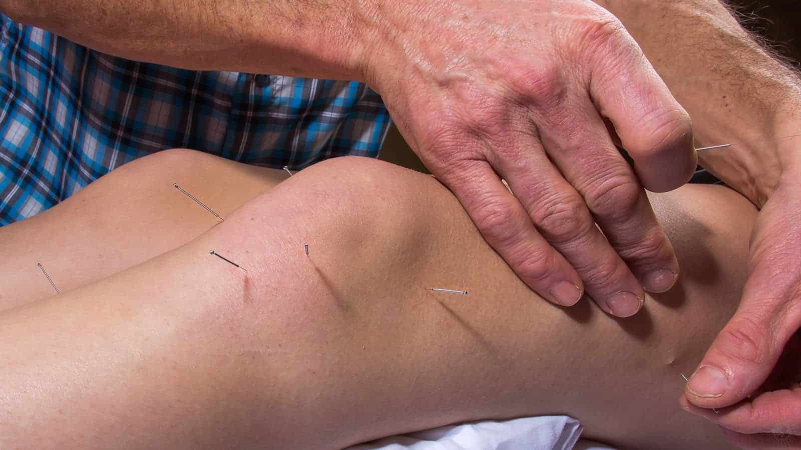 dry needling