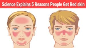 bursitis might cause red skin
