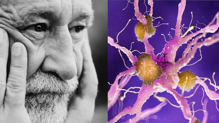 alzheimers