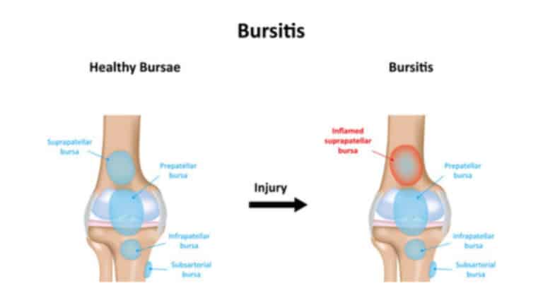 bursitis