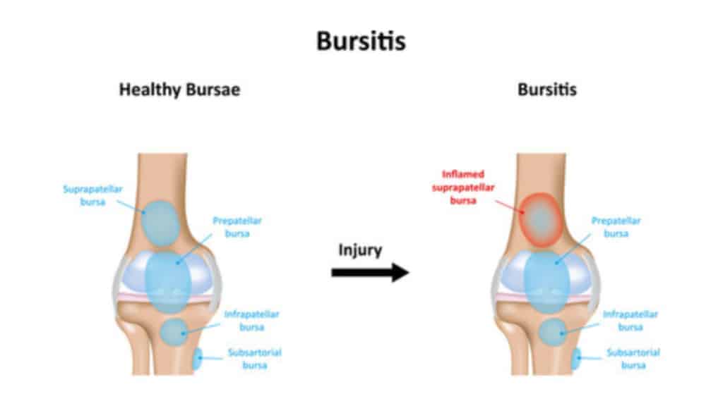 10 Early Signs of Bursitis to Never Ignore
