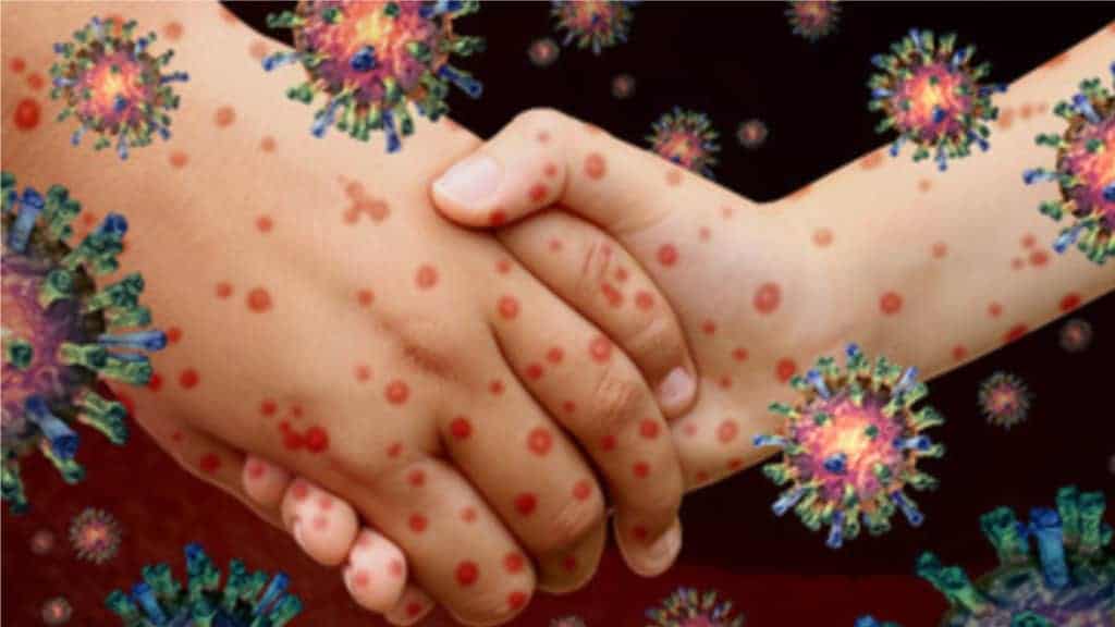 Chickenpox: Symptoms, Causes, Treatment, and Prevention