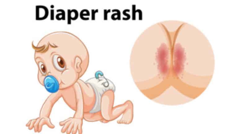 diaper rash