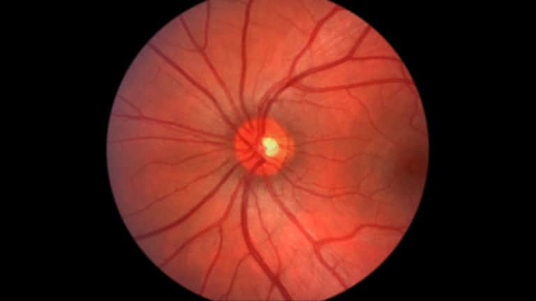 glaucoma
