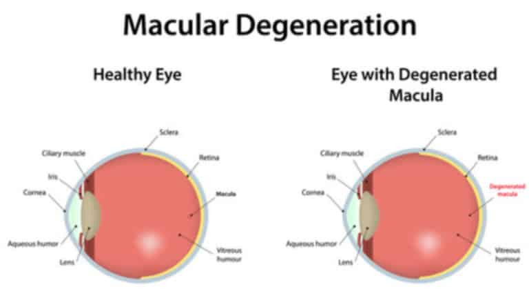 macular degeneration