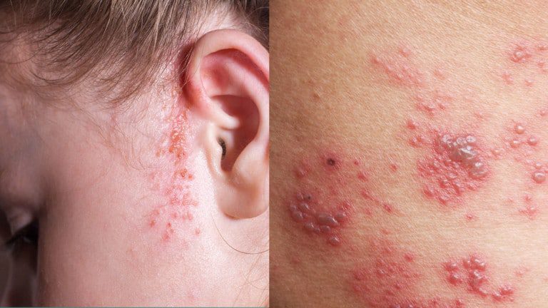 dermatologic disease
