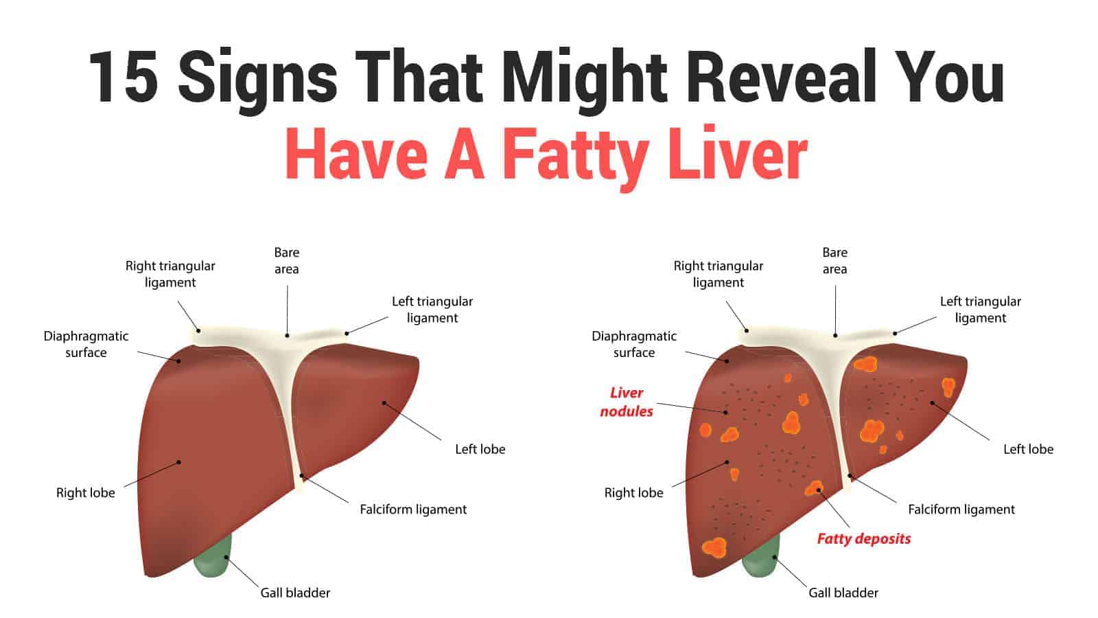 15 Signs That Might Reveal You Have A Fatty Liver