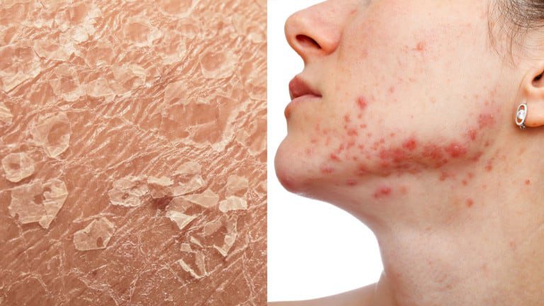 stressed skin