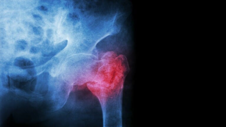 broken hip