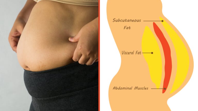 tummy tuck