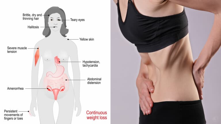 anorexia