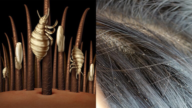 head lice