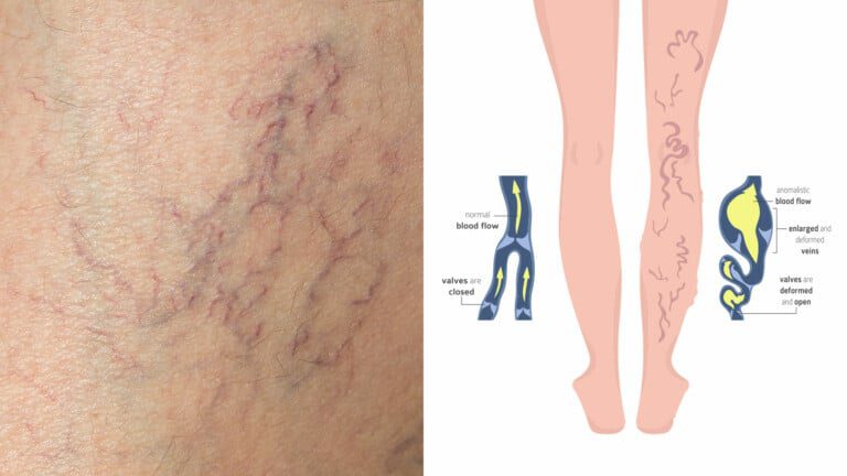 spider veins