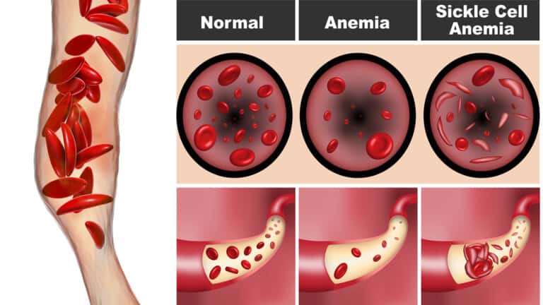 sickle cell anemia