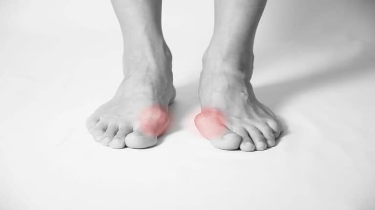 bunions