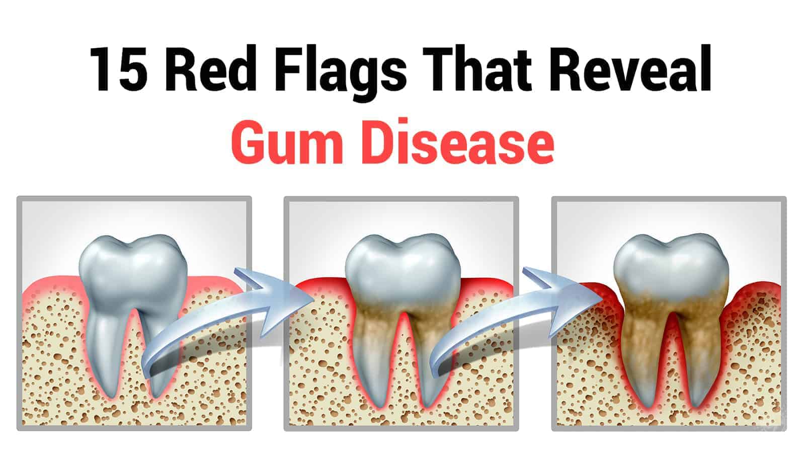 15 Red Flags That Reveal Gum Disease