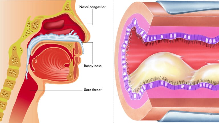 nasal congestion